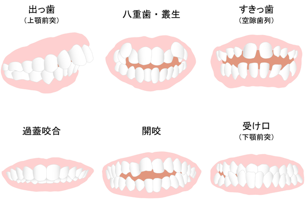 歯並びの種類