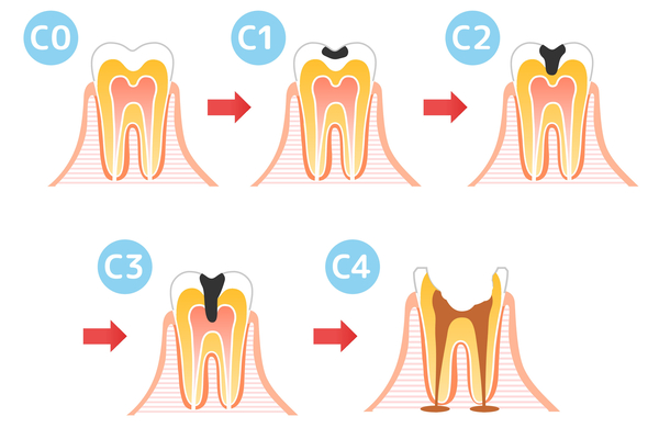 虫歯の進行