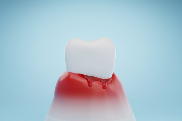 歯周病のイメージ