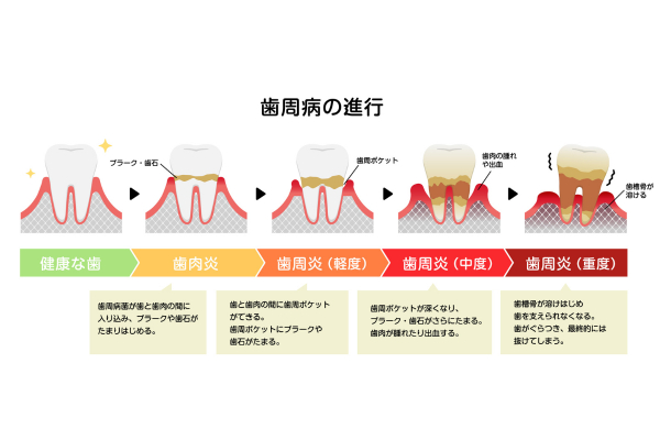 歯周病の進行