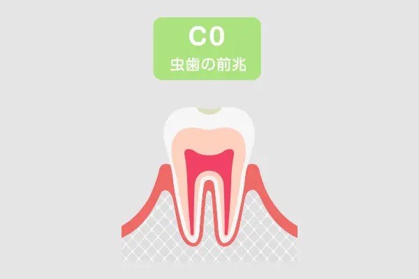 C0(初期虫歯)