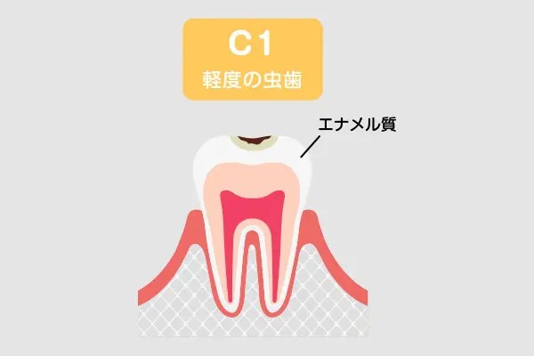 C1(エナメル質の虫歯)