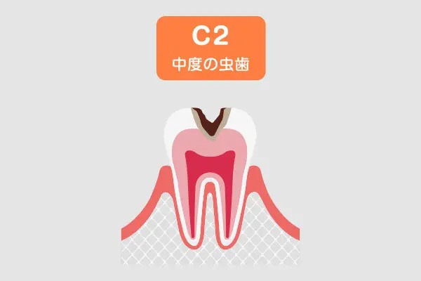 C2(象牙質の虫歯)