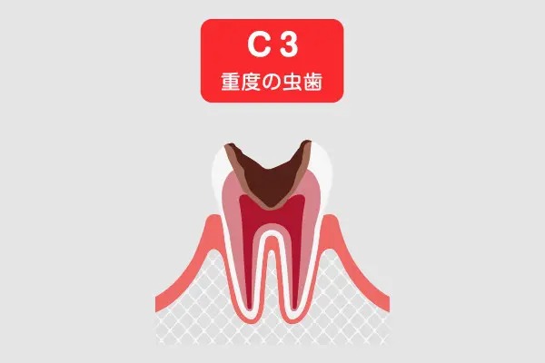 C3(神経まで達した虫歯)