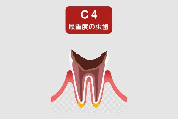 C4(歯根まで達した虫歯)