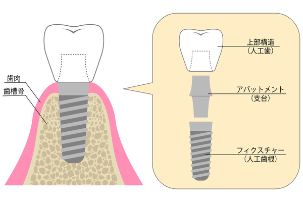 インプラントの構造