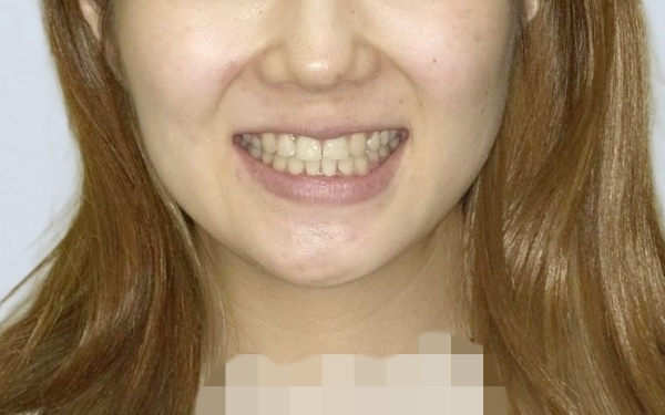 20代女性 反対咬合（受け口）の顎変形症をサージェリーファースト法による骨切り手術を併用した外科矯正で改善した症例 画像