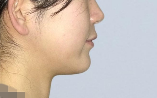 20代女性 過去のマウスピース矯正で突き出てしまった口元をマルチブラケット装置とアンカースクリューを併用した矯正治療で改善しEラインを整えた症例 画像